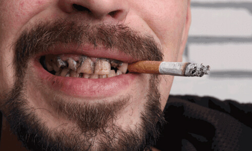 Проблемы с зубами у курильщиков