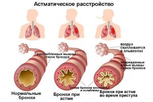 Состояние бронхов при астме