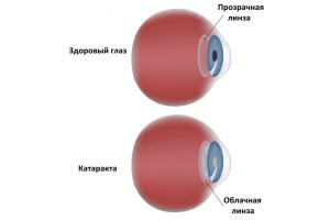 Развитие катаракты при курении