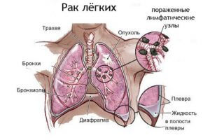 Рак легких как последствие курения