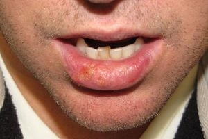 Рак губ при запущенном состоянии лейкоплакии курильщика