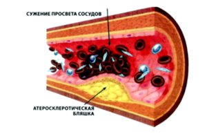 Схема атеросклероза