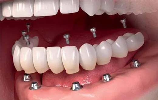 Полная имплантация зубов в Краснодаре