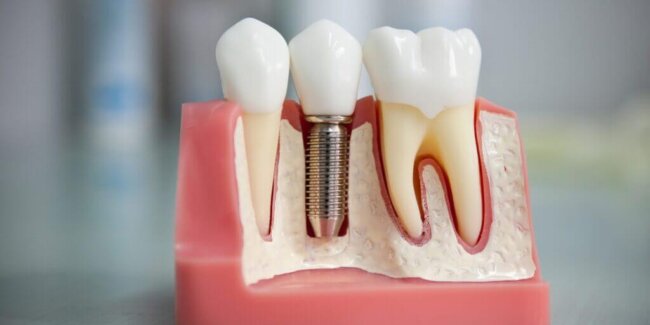 Имплантация зубов: суть и преимущества