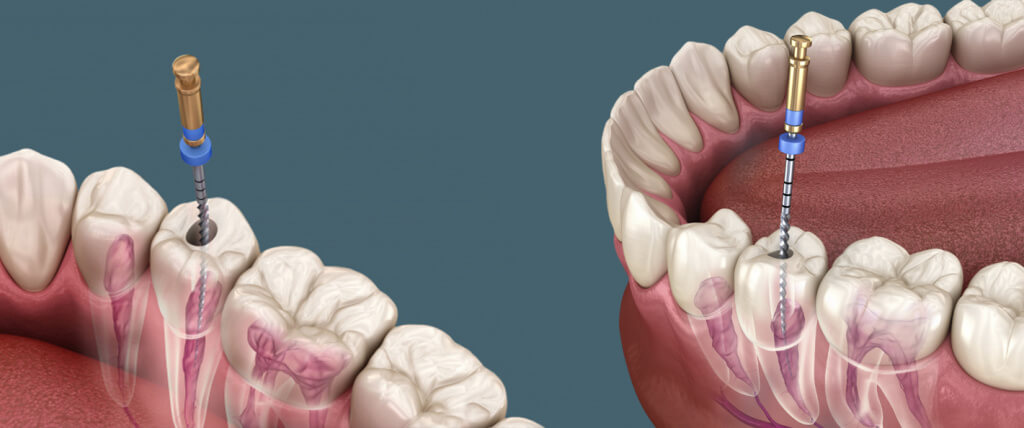 Лечение зубов без боли и стресса: опыт клиники Вэнстом